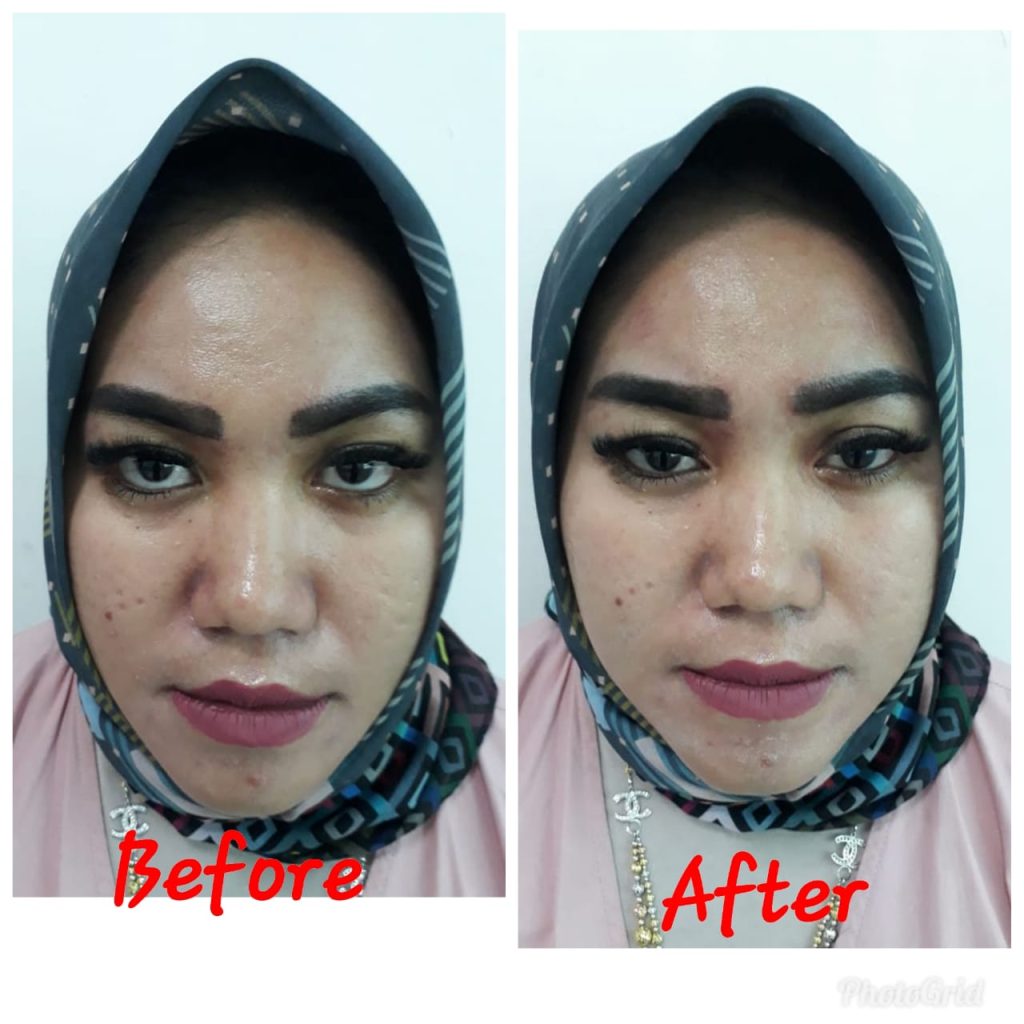 terapi facelift wajah