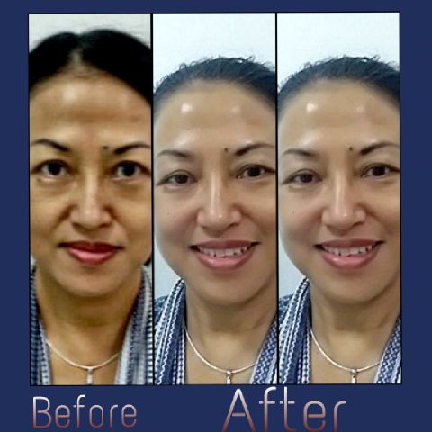 facelift wajah