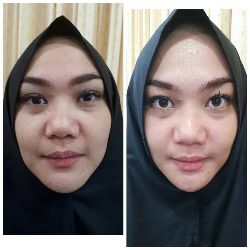 facelift kantong mata
